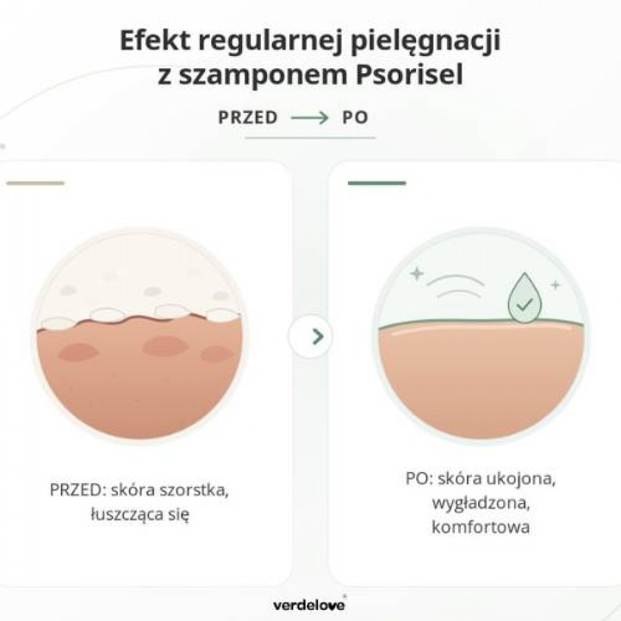 #2 – PSORISEL Szampon do pielęgnacji sk&oacute;ry głowy u os&oacute;b z objawami łuszczycy, 200ml