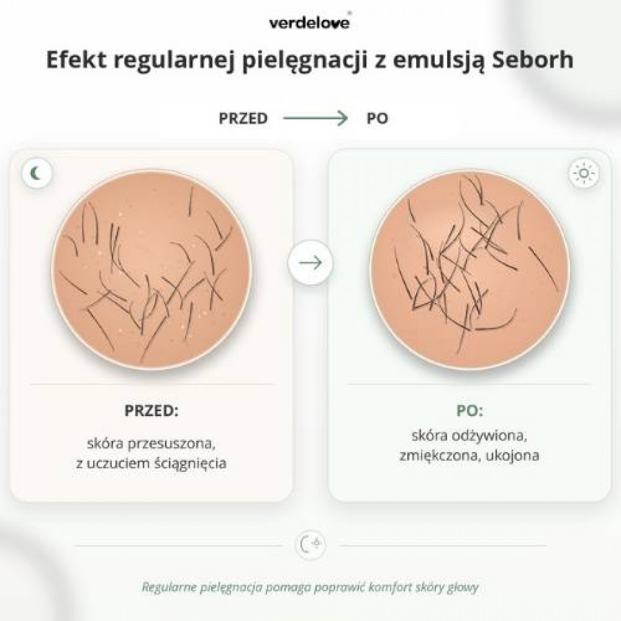 #2 – SEBORH Emulsja do łojotokowej sk&oacute;ry głowy, 200ml