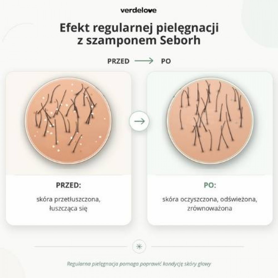 #2 – SEBORH Szampon do łojotokowej sk&oacute;ry głowy, 200ml