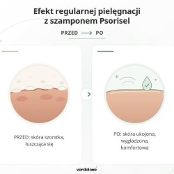 #2 – PSORISEL Szampon do pielęgnacji sk&oacute;ry głowy u os&oacute;b z objawami łuszczycy, 200ml