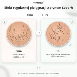 #2 – SEBORH Płyn do łojotokowej sk&oacute;ry głowy, 150ml