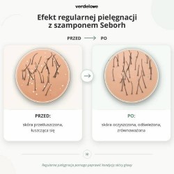 #2 – SEBORH Szampon do łojotokowej sk&oacute;ry głowy, 200ml